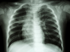 Календарь Морозовска: В октябре 1949 года восстановившийся после войны Морозовск получил рентгеновскую аппаратуру