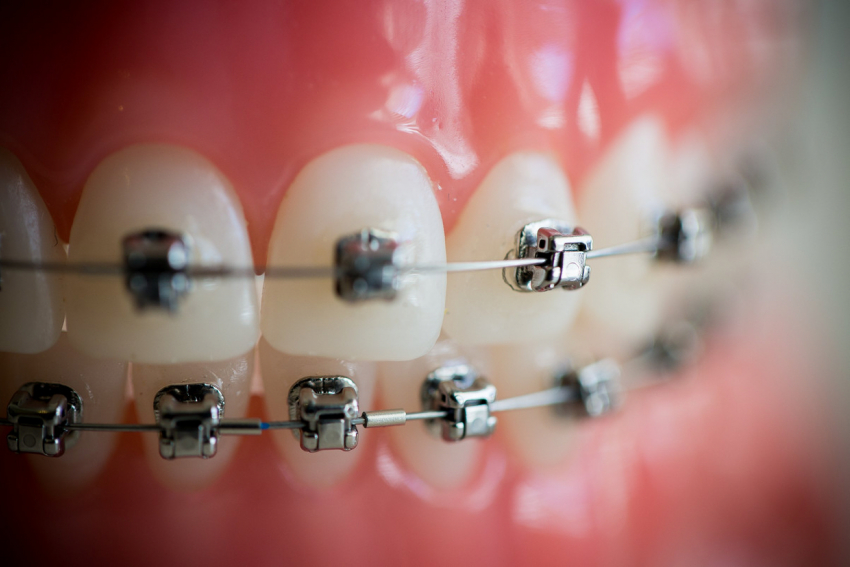 Хочешь поставить брекеты? Заходи в Справочник